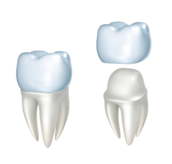 dental crown model manassas va 