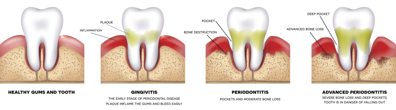 progression of gum disease manassas va dentist office