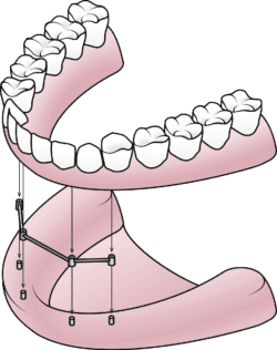 implant secured denture diagram manasass va dentist office 